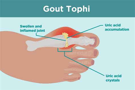 Pathophysiology | Gout