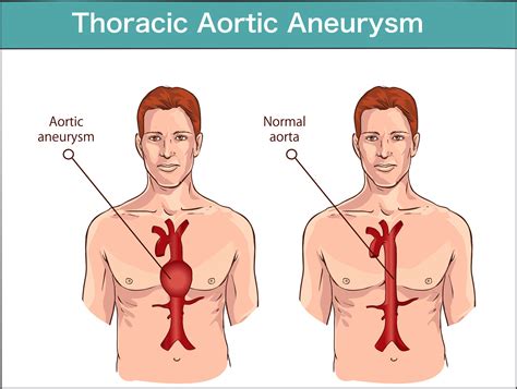 Thoracic Aortic Aneurysm & Aortic Dissection | Marfan Foundation