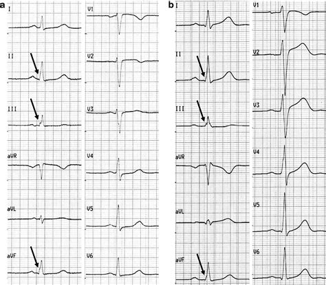 QRS complex abnormalities in subjects with idiopathic ventricular ...