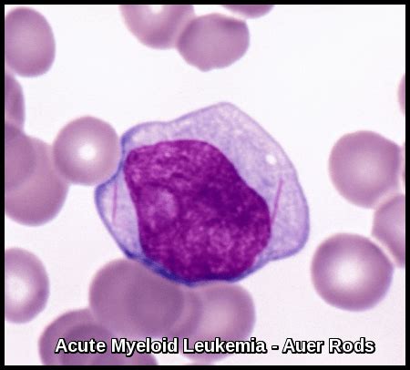 Acute Myeloid Leukemia | Ask Hematologist | Understand Hematology