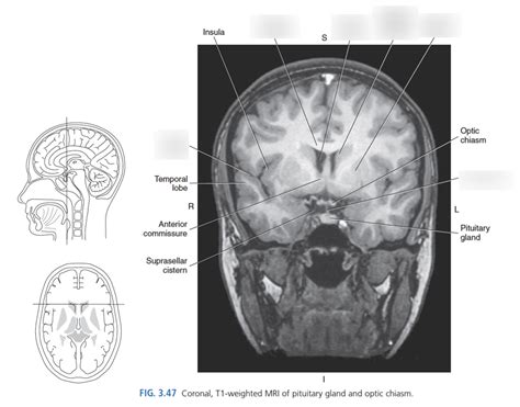 MRI Brain Anatomy Axial Diagram Quizlet, 49% OFF