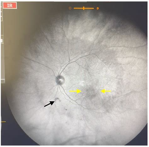 JCM | Free Full-Text | Visualization and Grading of Vitreous Floaters ...