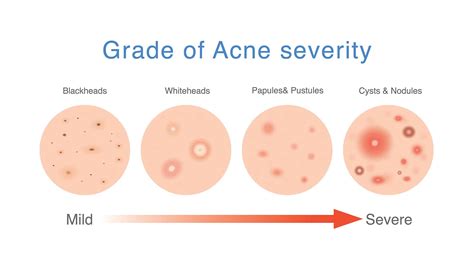 What Causes Cystic Acne And How To Treat It Effectively | SL Aesthetic ...