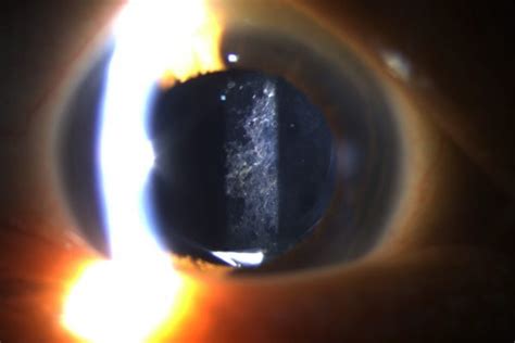 YAG Capsulotomy (YAG Laser Eye Surgery) - Vitreous Retina Macula ...