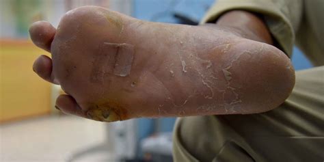 Learn about the Cause and Prevention of Diabetic Foot Ulcers | WCEI