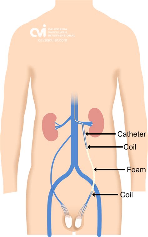 Non-Surgical Embolization California | Varicocele Doctor