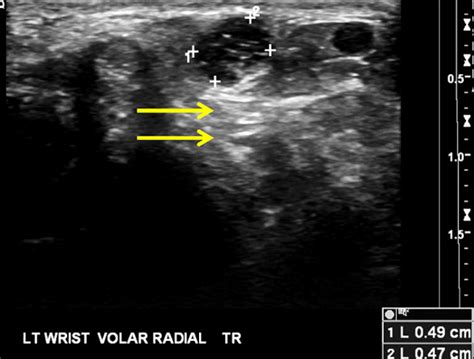 Wrist Ganglion Cysts | Radsource