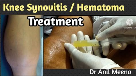 knee joint synovitis treatment | knee joint hematoma treatment | knee ...