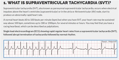 Ventricular Tachycardia Vs Supraventricular Tachycardia