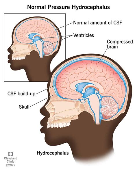 Normal Pressure Hydrocephalus (NPH): Symptoms & Treatment