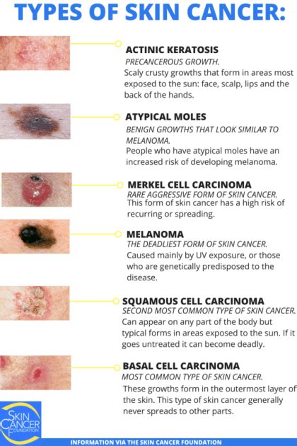 Skin Cancer Types | Basal Cell Carcinoma (BCC) | Squamous Cell ...