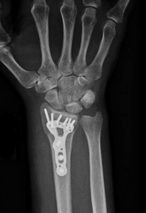 Distal Radius Fracture Wrist Fractures | Images and Photos finder