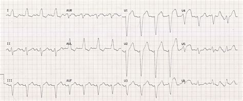 How to Diagnose Left Bundle Branch Block with ECG | New Health Advisor