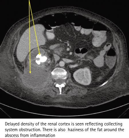 Perinephric abscess - Gardiner - 2011 - BJU International - Wiley ...