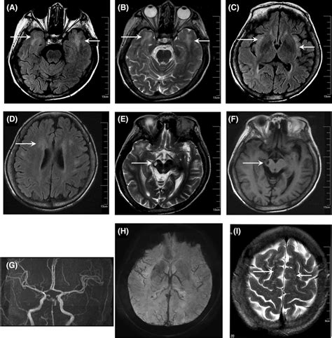 MRI images of this patient. Axial FLAIR (A) and T2‐weighted (B) images ...