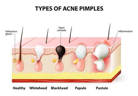 What is the Causes of Pimples? - Beauty Smart Care