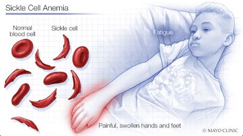 Sickle cell anemia is an inherited form of anemia - Mayo Clinic News ...