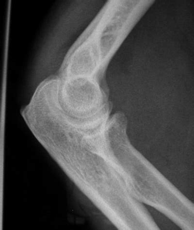 Elbow X Ray Fracture