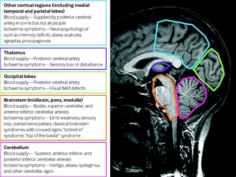 Posterior circulation ischaemic stroke | The BMJ