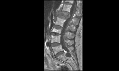 Bone Density Scan (DXA or DEXA) | UCSF Radiology