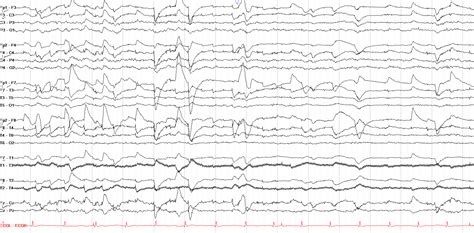 The Normal Asleep EEG