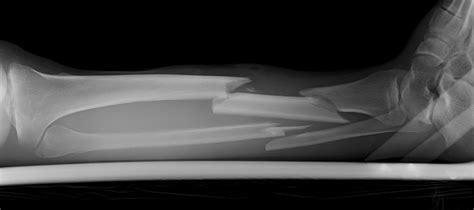 Broken Leg Xray Image Side View Stock Photo - Download Image Now - iStock