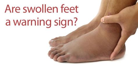 FootSmart Blog » How Serious Are Swollen Feet? | Swollen feet, Swelling ...