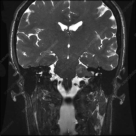 Vestibular Schwannoma, MRI - Stock Image - C039/4312 - Science Photo ...