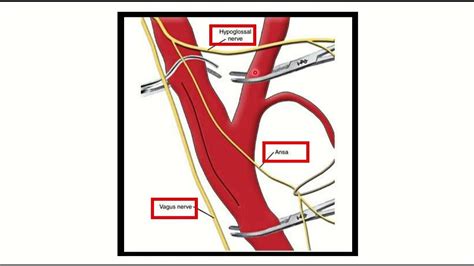 Carotid endarterectomy nerve damage MRCS question solve (CRACK MRCS ...