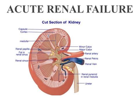 Acute Renal Failure Causes and Symptoms