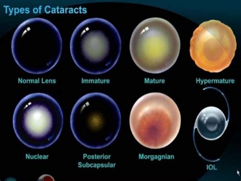 CATARACT DISEASE.