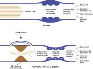 Claudication - Physiopedia