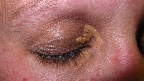 Xanthelasma: Treatment, Causes, Photo, and More