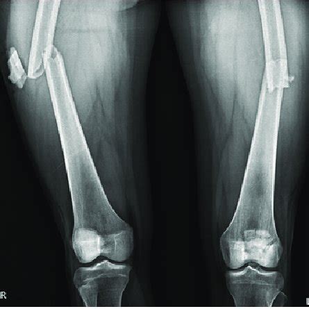 Plain radiograph showing bilateral femur shaft fracture with comminuted ...