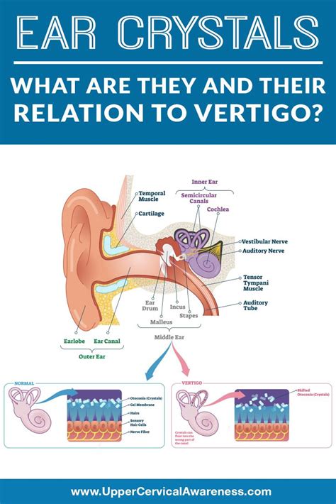 Ear Crystals: What Are They and Their Relation to Vertigo? | Vertigo ...