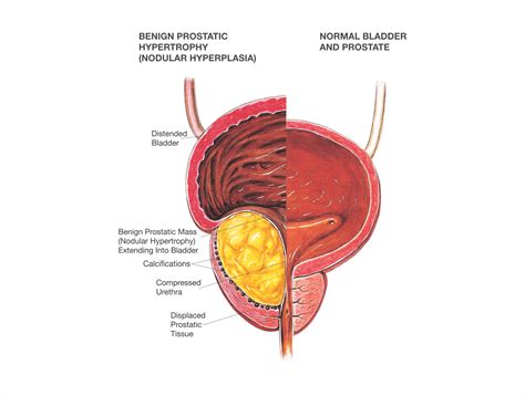 Best Hospital for Kidney Stones Treatment in Hyderabad, Cost & Benefit