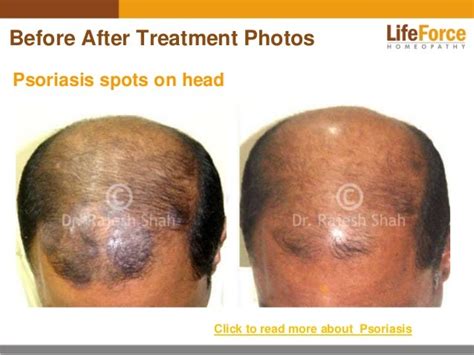 Psoriasis on Scalp & Head Photos: Before After Treatment Pictures