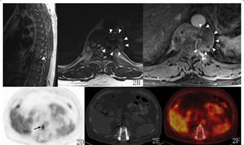 A 45-year-old male with benign GCTTS. The lesion was hypointense on ...