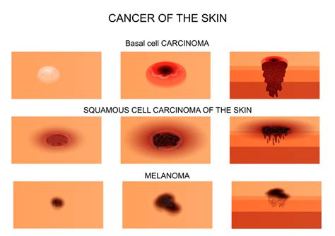 3 Skin Cancer Types and Their Warning Signs - University Health News