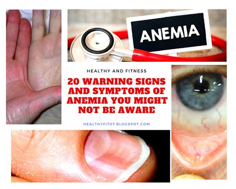 20 Warning Signs And Symptoms Of Anemia You Might Not Be Aware