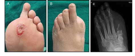 Figure 1 from Plantar rotational flap technique for panmetatarsal head ...