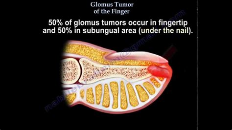 Glomus Tumor Of The Finger - Everything You Need To Know - Dr. Nabil ...