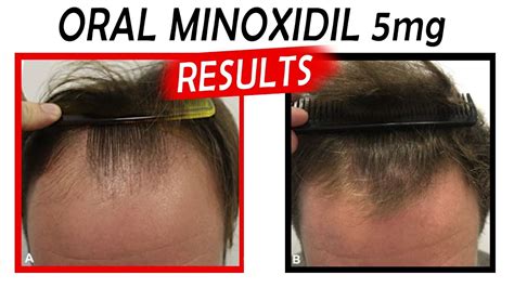 eszközök Tabletta lefoglal minoxidil 5 before and after Fuss feneketlen ...