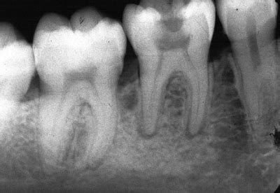 Periodontitis Periapical; Periodontitis Apical; Periodontitis Aguda no ...