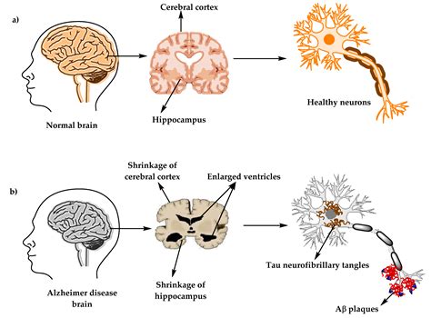 Molecules | Free Full-Text | Comprehensive Review on Alzheimer’s ...