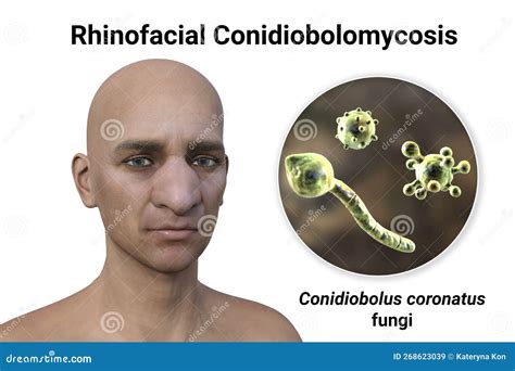 Rhinofacial Conidiobolomycosis in a Man and Conidiobolus Coronatus ...