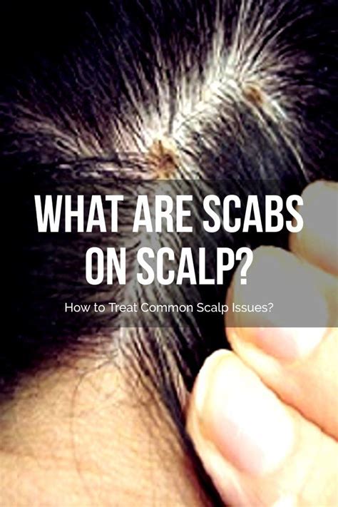 How To Clear Up Your Scalp A Step By Step Guide - The 2023 Guide to the ...