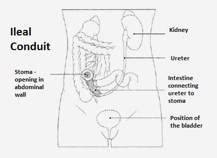 Ileal Conduit