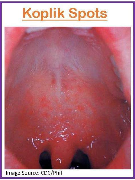 Measles (Rubeola): Symptoms, Prevention - We Care