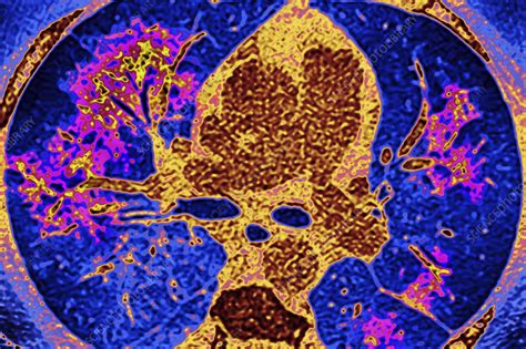 Pulmonary vasculitis, CT scan - Stock Image - C055/6172 - Science Photo ...